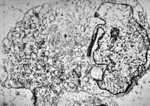 F,55y. | leiomyosarcoma - omentum F,55y. | leiomyosarcoma - omentum